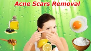 acne-remedies