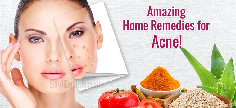 home remedies for acne