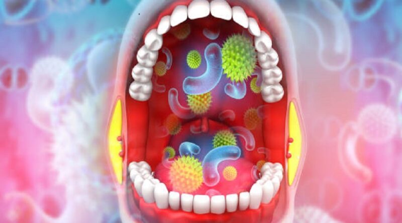 Tonsillitis