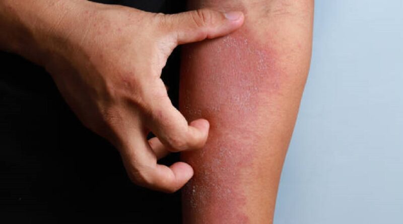 cure eczema